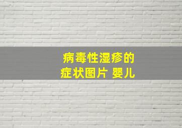 病毒性湿疹的症状图片 婴儿